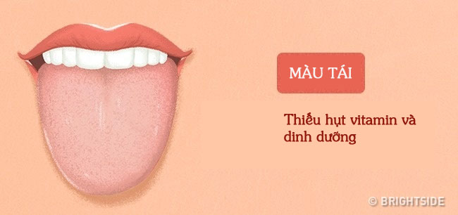 Tư vấn - Màu sắc lưỡi tiết lộ các vấn đề sức khỏe  (Hình 3).