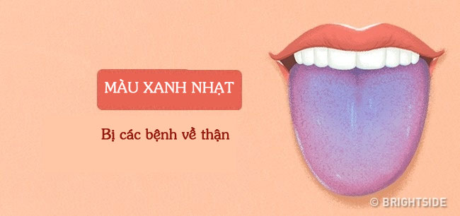 Tư vấn - Màu sắc lưỡi tiết lộ các vấn đề sức khỏe  (Hình 2).