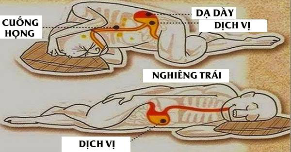 Nằm bên nào tốt cho tim: Khám phá tư thế ngủ lý tưởng cho sức khỏe tim mạch