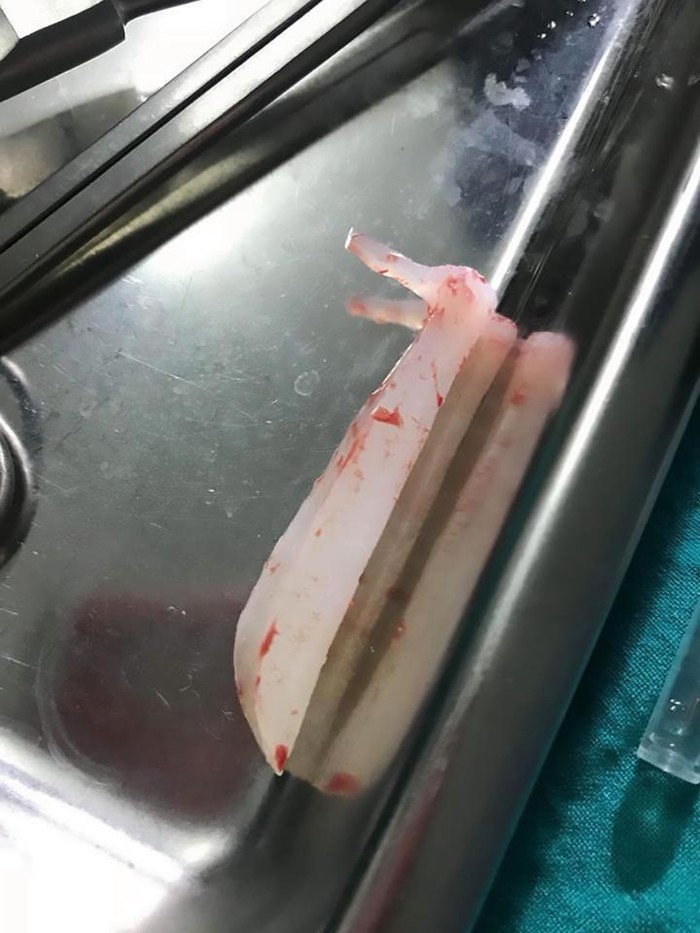 Xã hội - Mũi lồi silicone vì thẩm mỹ hỏng, phụ nữ xinh thành phim kinh dị (Hình 2).