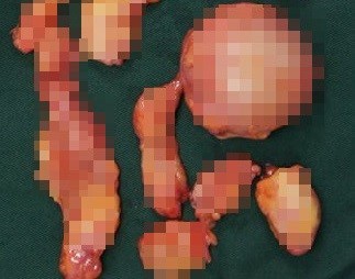 Xã hội - Mũi lồi silicone vì thẩm mỹ hỏng, phụ nữ xinh thành phim kinh dị (Hình 4).