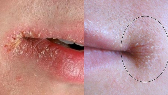 Các bệnh - Không tham ăn mà vẫn bị chốc mép: Lời cảnh báo từ cơ thể