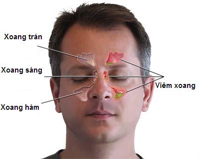 Bệnh viêm xoang - Nguyên nhân và cách phòng ngừa (Hình 2).