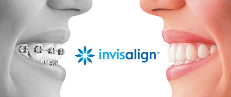 Truyền thông - Chỉnh nha Invisalign – niềng răng vô hình, hoàn thiện nụ cười