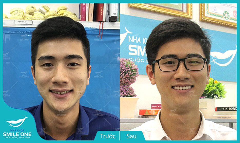 Truyền thông - Tìm lại hàm răng thẳng đều, nụ cười tươi sáng với công nghệ chỉnh nha Invisalign tại Nha Khoa Smile One (Hình 3).
