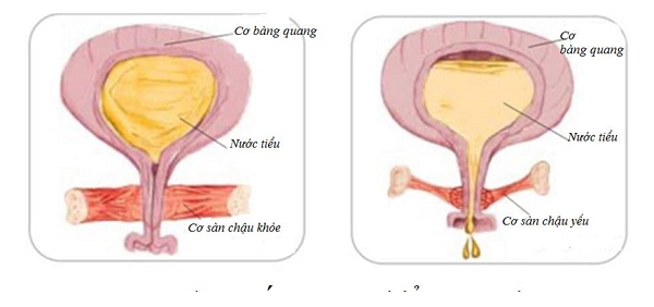 Sức khỏe - Tiểu són, tiểu nhiều lần, tiểu gấp, hội chứng bàng quang kích thích: Phải làm sao?