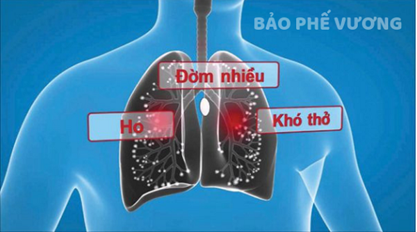 Sức khỏe - Ho, đờm kéo dài do viêm phế quản phải làm sao?