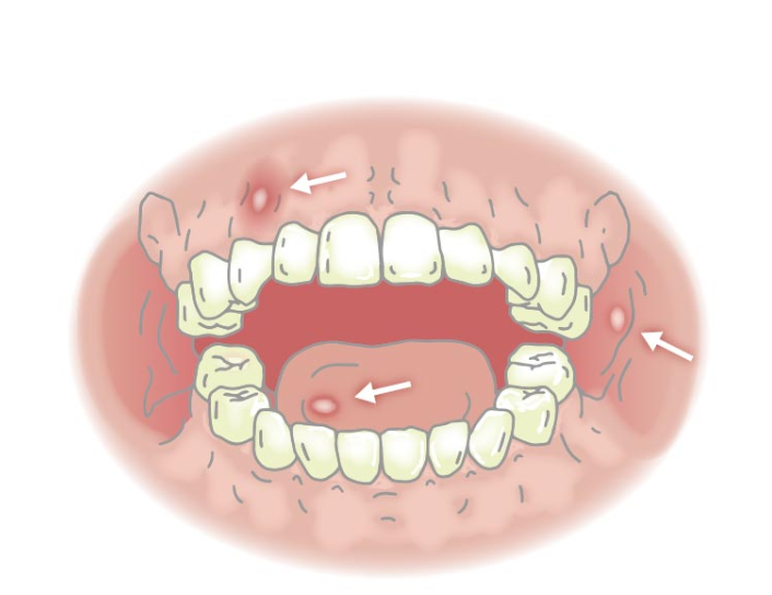 Sức khỏe - Bệnh ngoài da do virus thủy đậu, sởi, viêm loét miệng,... là gì? (Hình 2).