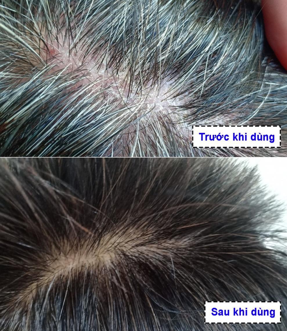 Sức khỏe - Không còn mất ngủ triền miên vì ngứa do vảy nến da đầu nhờ dùng sản phẩm này sau 2 tháng! (Hình 6).