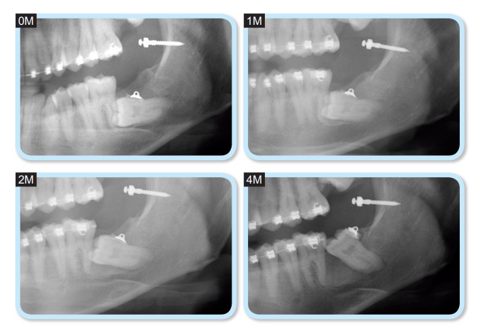 Truyền thông - Hé lộ phương pháp mới giúp khắc phục tình trạng răng khôn mọc ngầm, mọc ngang mà không cần nhổ (Hình 3).