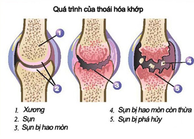 Truyền thông - 5 NÊN khi bị THOÁI HÓA KHỚP, người bệnh nào cũng PHẢI BIẾT để không bị TEO CƠ, BIẾN DẠNG KHỚP, TÀN PHẾ