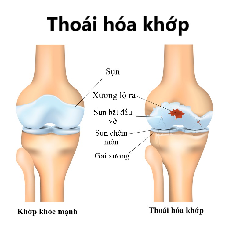 Truyền thông - 5 NÊN khi bị THOÁI HÓA KHỚP, người bệnh nào cũng PHẢI BIẾT để không bị TEO CƠ, BIẾN DẠNG KHỚP, TÀN PHẾ (Hình 2).