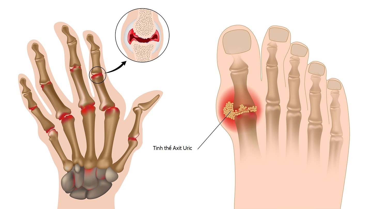 Tiêu dùng & Dư luận - Bác sĩ phân tích nước giải ion kiềm giúp giảm biến chứng bệnh gout (Hình 2).