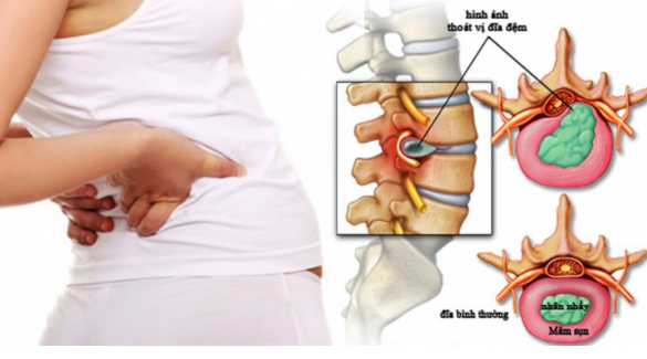 Sức khỏe - Bị thoát vị đĩa đệm cổ - Đừng lo đã có Cốt Thoái Vương?