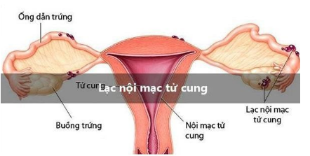 Sức khỏe - Nguy cơ vô sinh, hiếm muộn do lạc nội mạc tử cung và giải pháp cải thiện từ thảo dược!