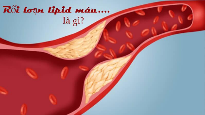 Sức khỏe - Tại sao Lipidcleanz là công thức độc đáo cho người rối loạn lipid máu?