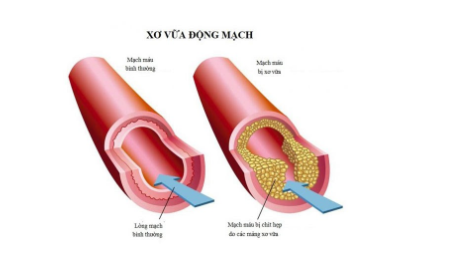 Sức khỏe - Chỉ số cholesterol tăng cao và lời cảnh báo đối với sức khỏe! (Hình 3).