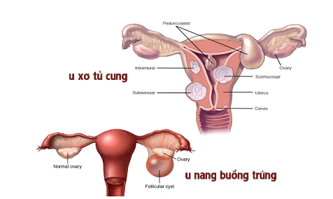 Sức khỏe - Nga Phụ Khang – Chìa khóa “vàng” giúp cải thiện u xơ tử cung, u nang buồng trứng