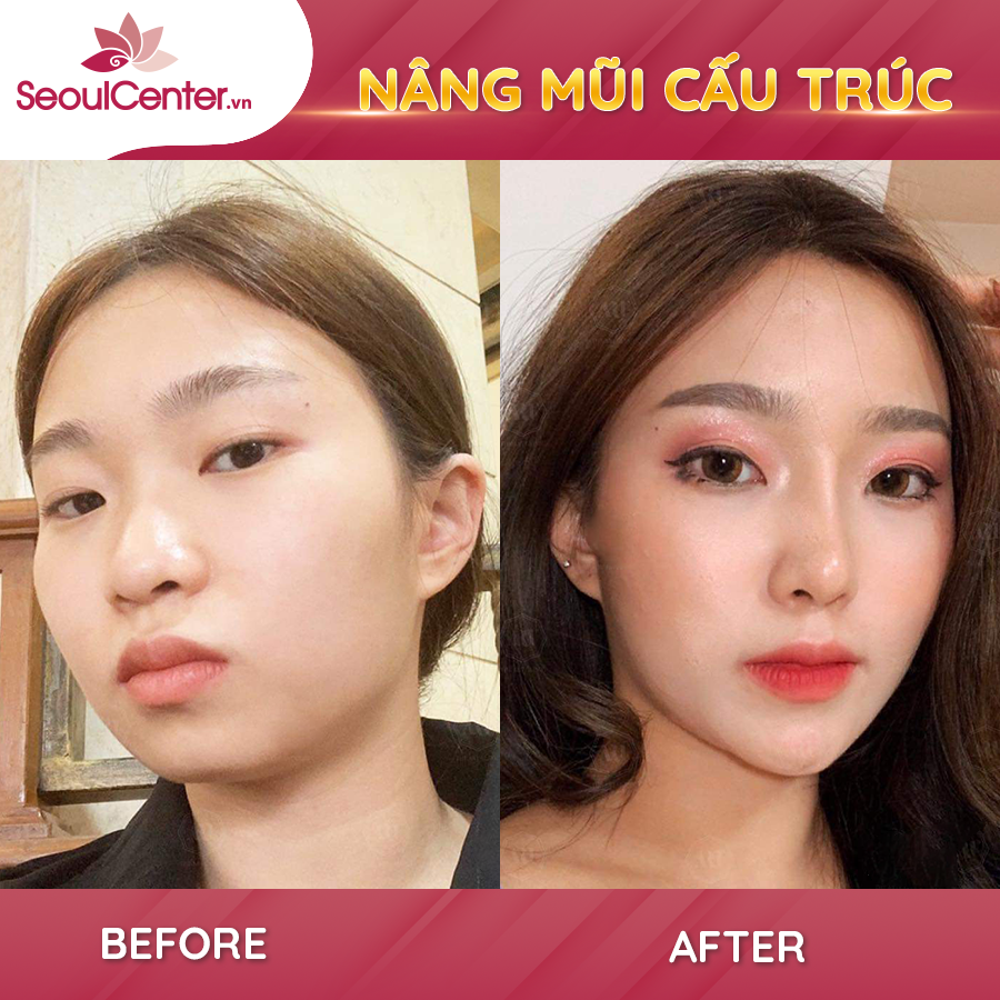 Sức khỏe - Nâng mũi cấu trúc có thực sự là giải pháp làm đẹp tốt nhất? (Hình 4).