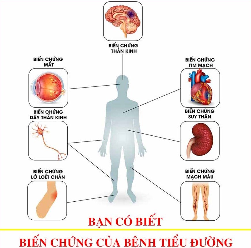 Sức khỏe - BoniDiabet –Bí quyết xua tan nỗi ám ảnh mang tên biến chứng tiểu đường