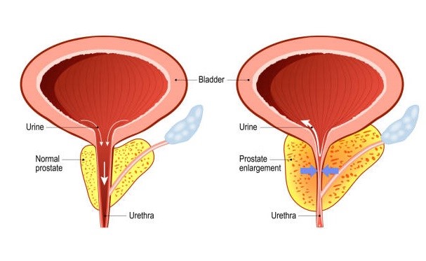 Sức khỏe - BoniMen – Bí quyết co nhỏ tuyến tiền liệt không cần phẫu thuật