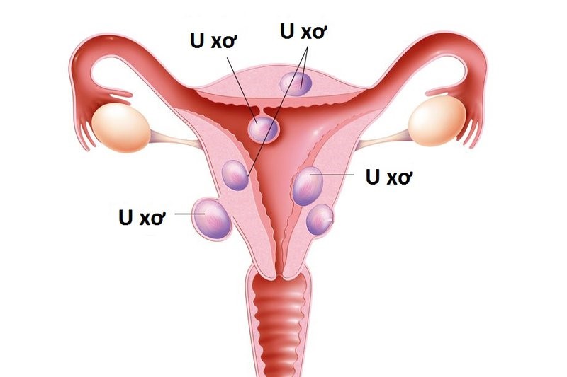 Sức khỏe - Xua tan nỗi lo u xơ tử cung nhờ Nga Phụ Khang