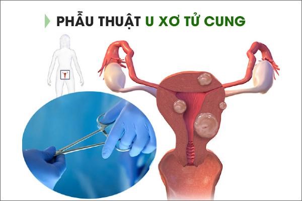 Sức khỏe - Xua tan nỗi lo u xơ tử cung nhờ Nga Phụ Khang (Hình 3).