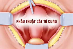 Sức khỏe - Xua tan nỗi lo lạc nội mạc tử cung nhờ Phụ Lạc Cao EX (Hình 2).