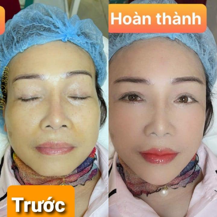 Cần biết - Bác sĩ thẩm mỹ Ngô Tuấn tái sinh nhan sắc Việt với công nghệ HA collagen tươi (Hình 3).