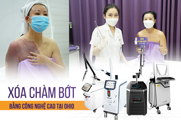 Cần biết - Thẩm mỹ OHIO khẳng định vị thế số 1 tại Việt Nam trong điều trị chàm bớt bẩm sinh (Hình 4).