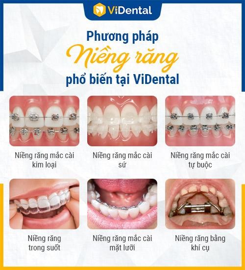 Cần biết - Niềng Răng Trả Góp Lãi Suất 0% tại ViDental: Cam Kết Bảo Hành TRỌN ĐỜI