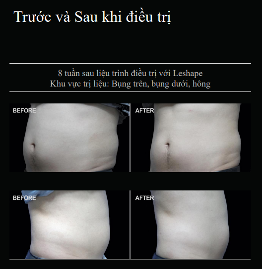 Cần biết - Thiết bị hỗ trợ săn chắc da không xâm lấn của Americare Clinic là gì? Người dùng đã thực sự hiểu? (Hình 7).