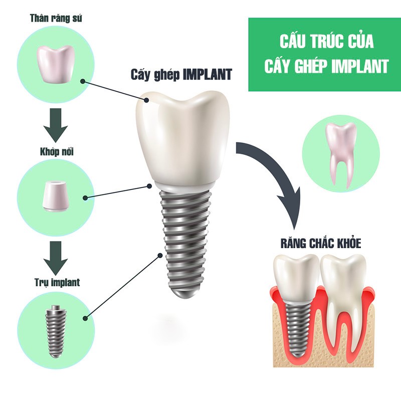 Cần biết - Những điều bạn cần biết về kỹ thuật cấy ghép Implant