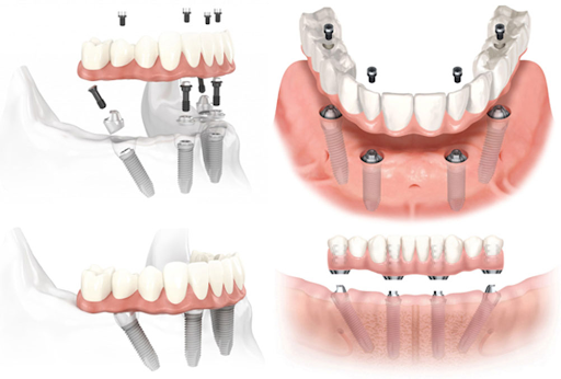 Cần biết - Những điều bạn cần biết về kỹ thuật cấy ghép Implant (Hình 2).