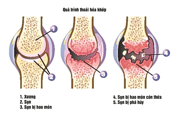 Cần biết - Bác sĩ Trần Minh – cải thiện chất lượng cuộc sống cho bệnh nhân thoái hóa khớp (Hình 2).