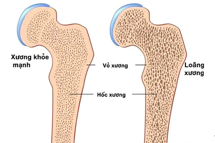 Sức khỏe - Top 5 biến chứng suy thận mạn nguy hiểm thường gặp  (Hình 2).