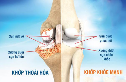 Sức khỏe - Biến chứng nặng của thoái hóa khớp và giải pháp cải thiện từ CốtWells