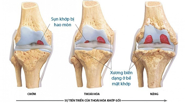 Sức khỏe - Biến chứng nặng của thoái hóa khớp và giải pháp cải thiện từ CốtWells (Hình 2).