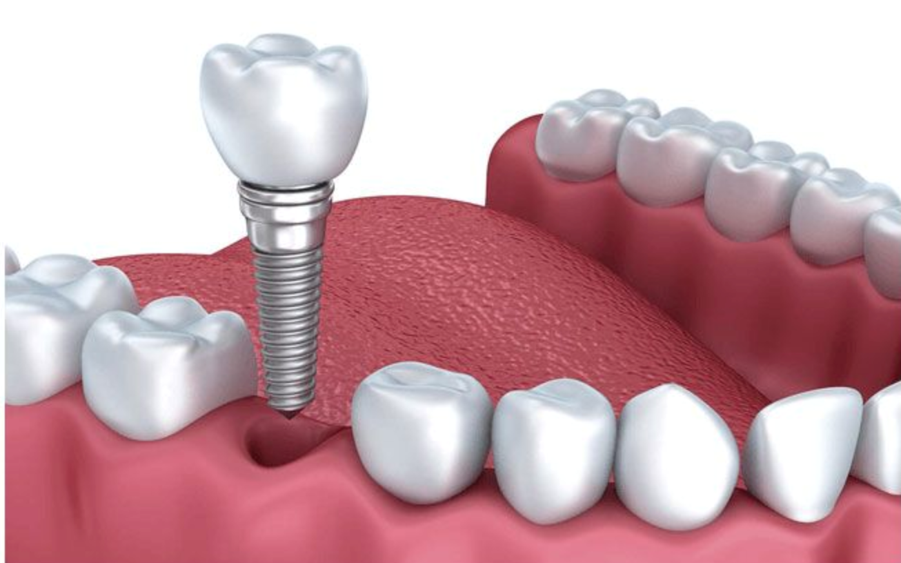 Cần biết - Bs Nha khoa quốc tế Amber chia sẻ nguy cơ biến chứng cấy ghép Implant không đúng (Hình 2).