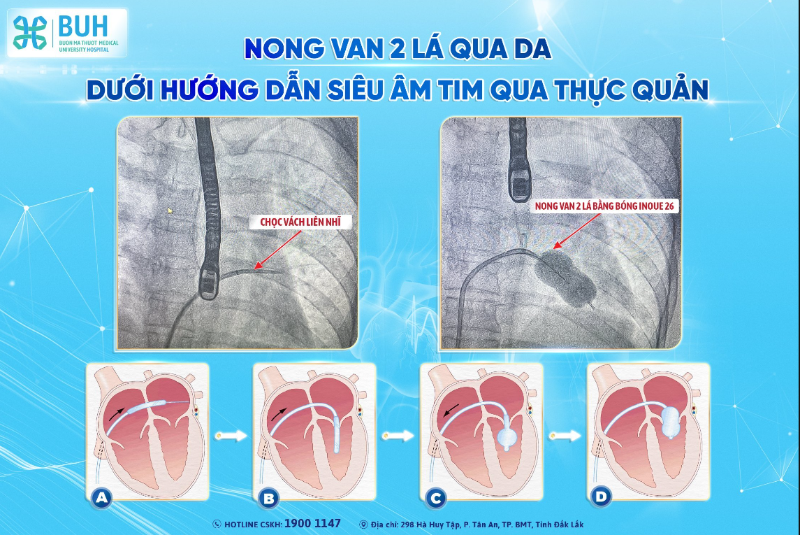 Cần biết - Hút huyết khối mạch não và nong van tim giúp bệnh nhân bị bệnh tim thoát “án tử” do đột quỵ não cấp (Hình 3).