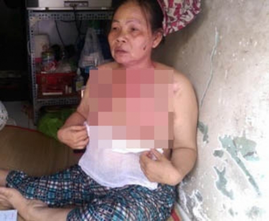 Pháp luật - Chủ nhà bị người thuê trọ tạt nước sôi vì… đòi tiền nhà