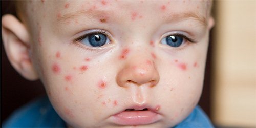 Đời sống - Cách phòng tránh và trị bệnh chốc lở cho bé mùa nóng