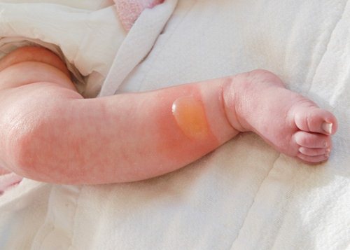 Đời sống - Cách phòng tránh và trị bệnh chốc lở cho bé mùa nóng (Hình 2).