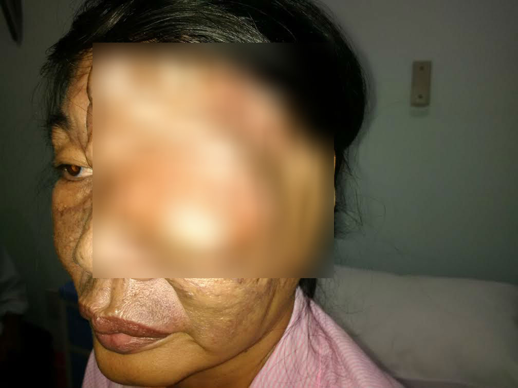 Đời sống - Cứu sống bệnh nhân mắc dị dạng mạch máu não hiếm gặp