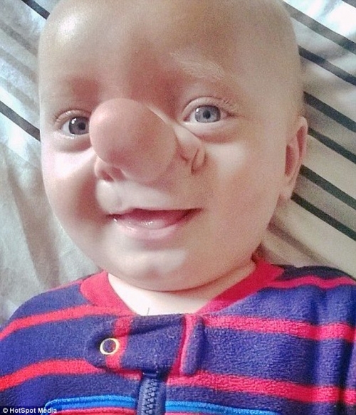 Đời sống - Căn bệnh lạ khiến cậu bé có mũi dài như Pinocchio