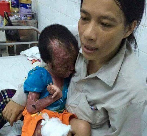 Pháp luật - Xót xa cậu bé bị bỏng khiến toàn bộ khuôn mặt, chân tay bị biến dạng (Hình 2).