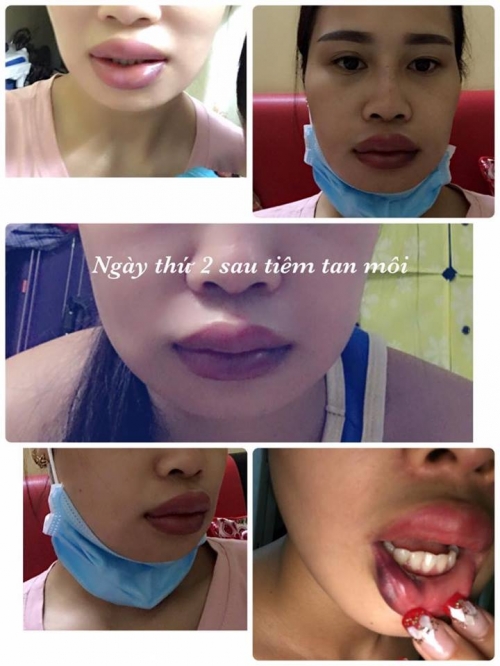 Ph&aacute;p luật - Spa Ph&uacute; Xu&acirc;n Beauty: Ti&ecirc;m filler hỏng m&ocirc;i c&ograve;n nhắn tin chửi kh&aacute;ch?