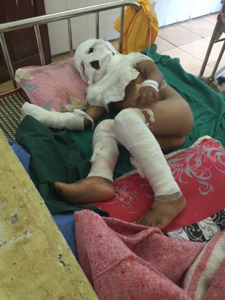 Ph&aacute;p luật - Qu&aacute; ngh&egrave;o 3 bố con bỏng nặng sắp bỏ viện về nh&agrave; v&igrave; hết tiền điều trị