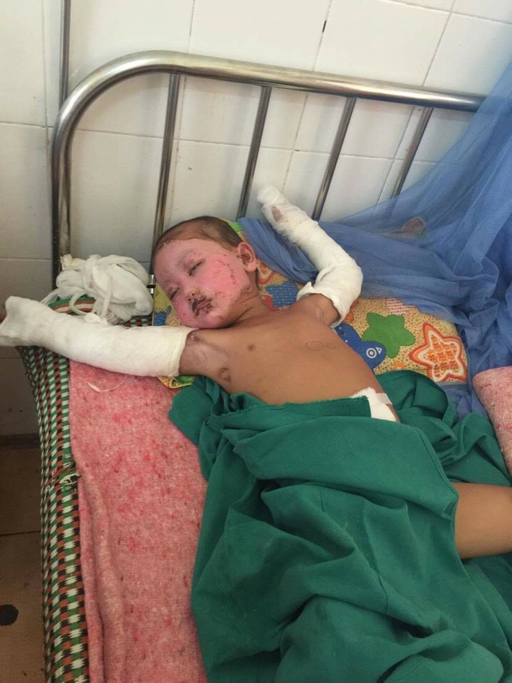 Ph&aacute;p luật - Qu&aacute; ngh&egrave;o 3 bố con bỏng nặng sắp bỏ viện về nh&agrave; v&igrave; hết tiền điều trị (H&igrave;nh 2).