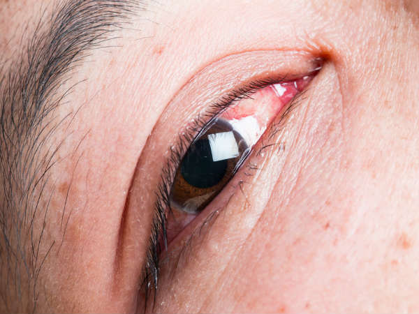Đời sống - Nguy hiểm khôn lường khi đeo kính áp tròng đi ngủ (Hình 4).